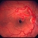 Retinal AVM case 2 image 1